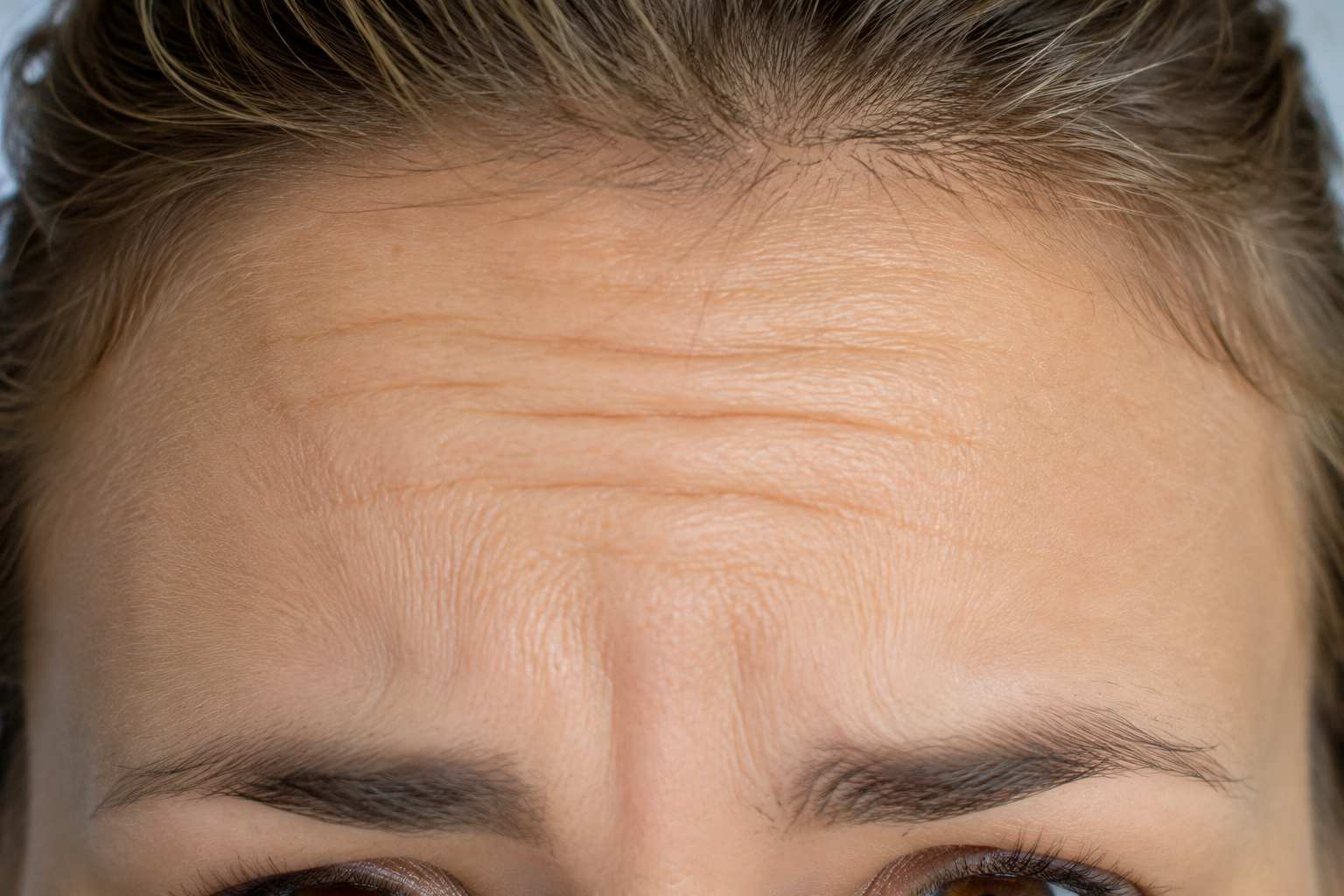 Forehead Lines & Smiles Lines